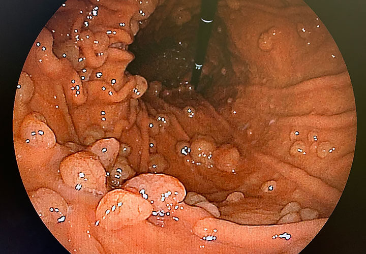 胃底腺ポリープ