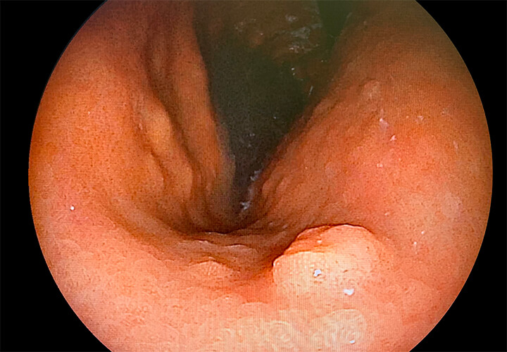 胃腺腫